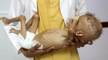 Yemen malnourished child AFP