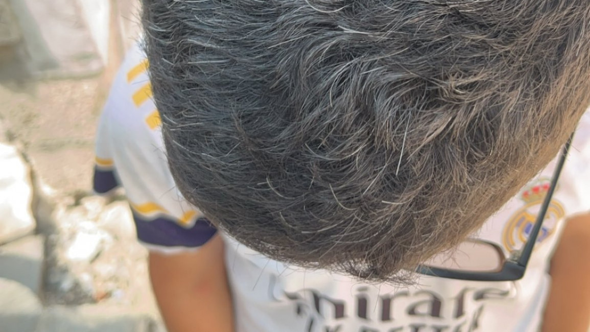 Children in Gaza are getting white hair due to stress and trauma [The New Arab/Supplied]